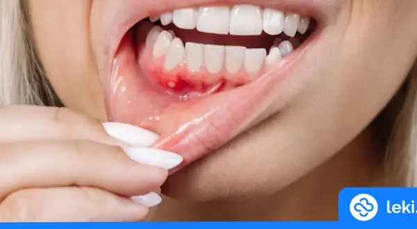Opuchnięte dziąsła: Domowe sposoby, które działają! Kiedy do dentysty?