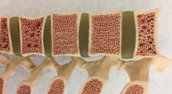 Model kręgosłupa z widocznymi ubytkami w kościach, ilustrujący osteoporozę objawy.