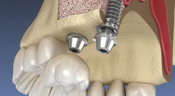Model szczęki z implantami i podniesionym dnem zatoki szczękowej. Zabieg sinus lift pozwala na wszczepienie implantów w przypadku braku kości.