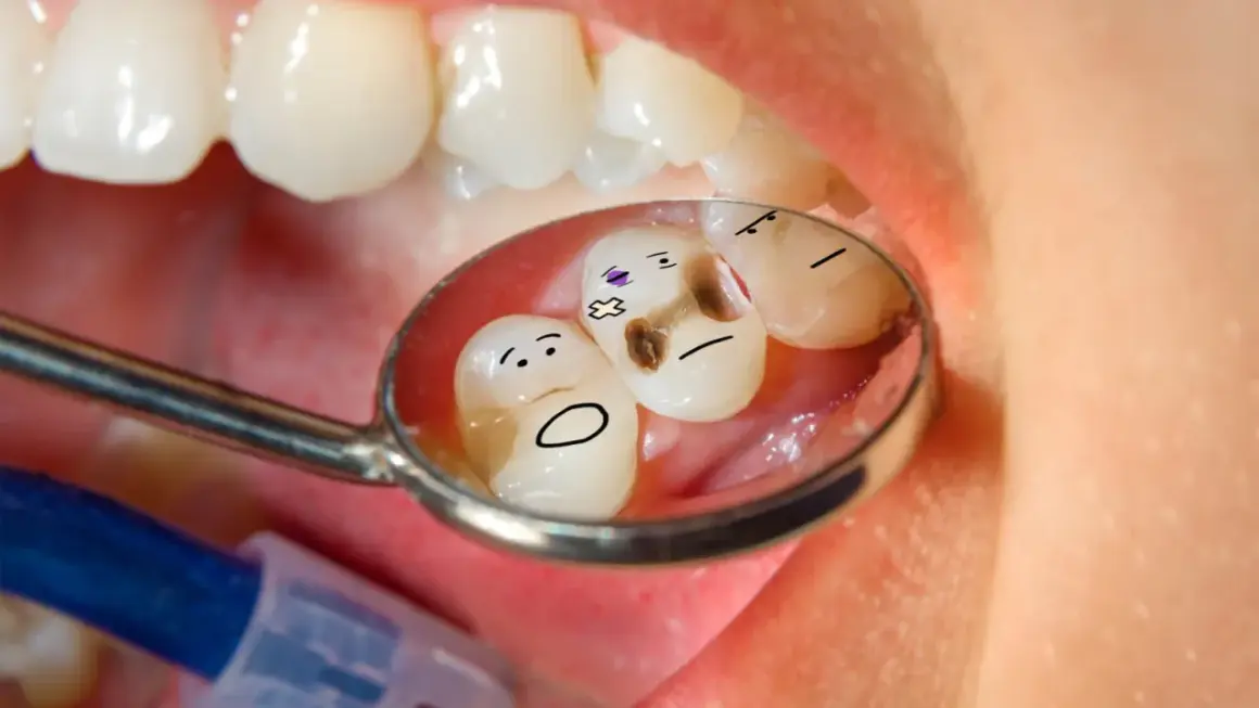 Zepsute ząbki z narysowanymi buźkami w lusterku dentystycznym. Brakuje im zdrowego **hydroksyapatytu**.
