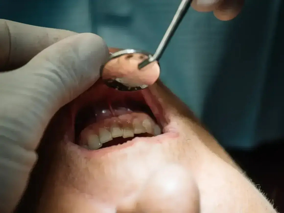 Dentysta bada jamę ustną, widoczne są zęby i dziąsła. Może to być nieleczony ropień zęba.