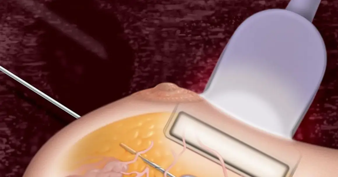 Ilustracja przedstawia biopsję piersi. Igła biopsyjna jest wprowadzana do tkanki piersi pod kontrolą ultrasonografu.