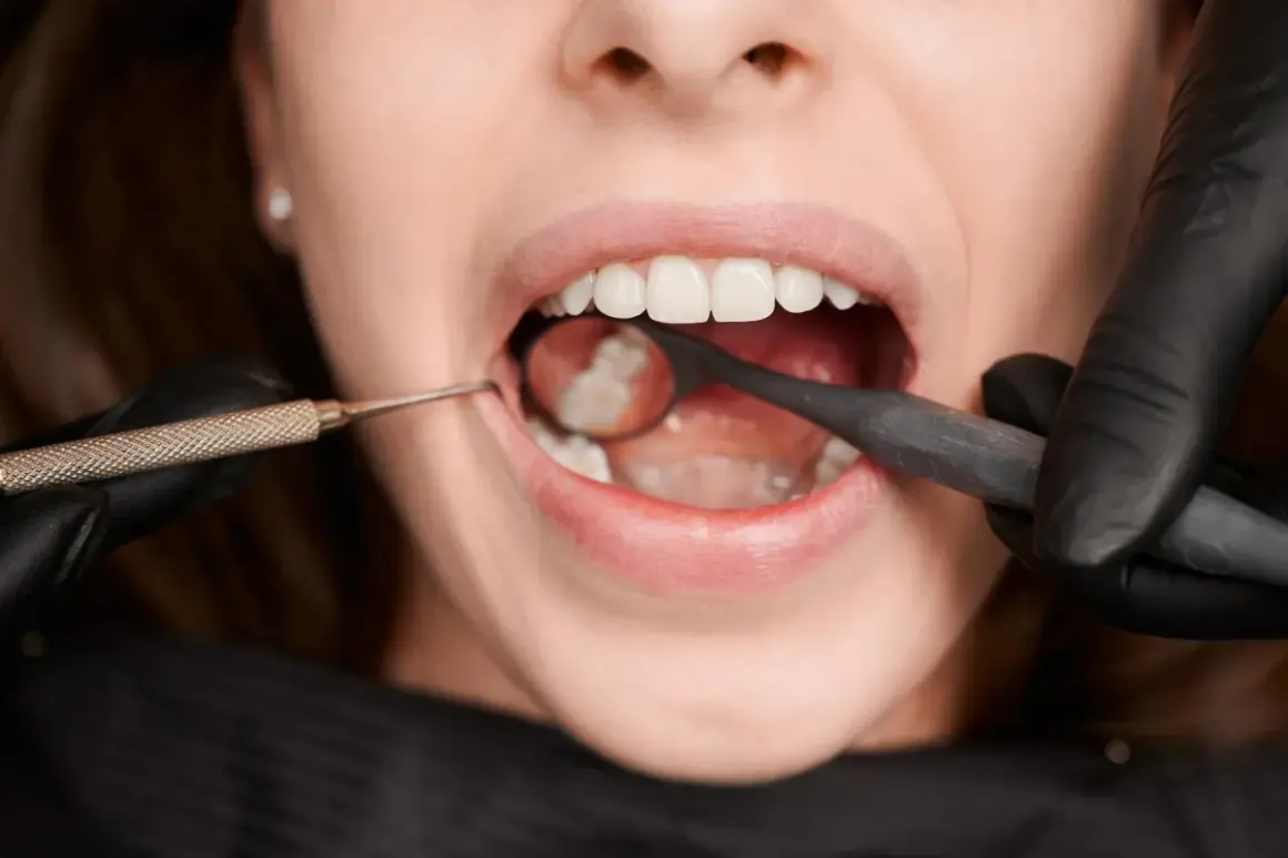 Usta pacjentki z widocznymi białymi plamami na zębach, badane przez dentystę przy użyciu lusterka i narzędzia.