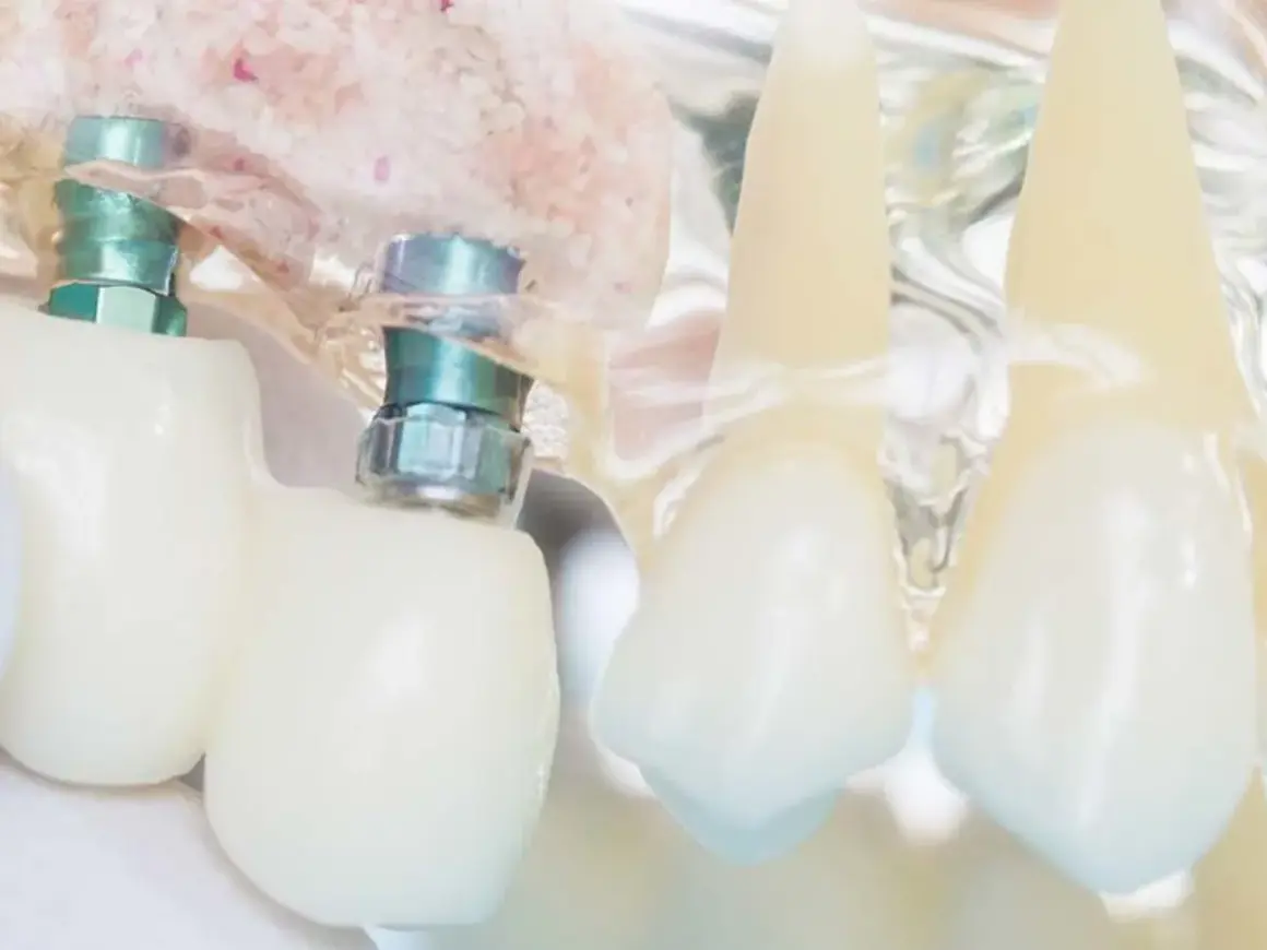 Model szczęki z implantami i koronami. Widoczne śruby mocujące, które mogą być przyczyną odrzucenia implantu zęba.