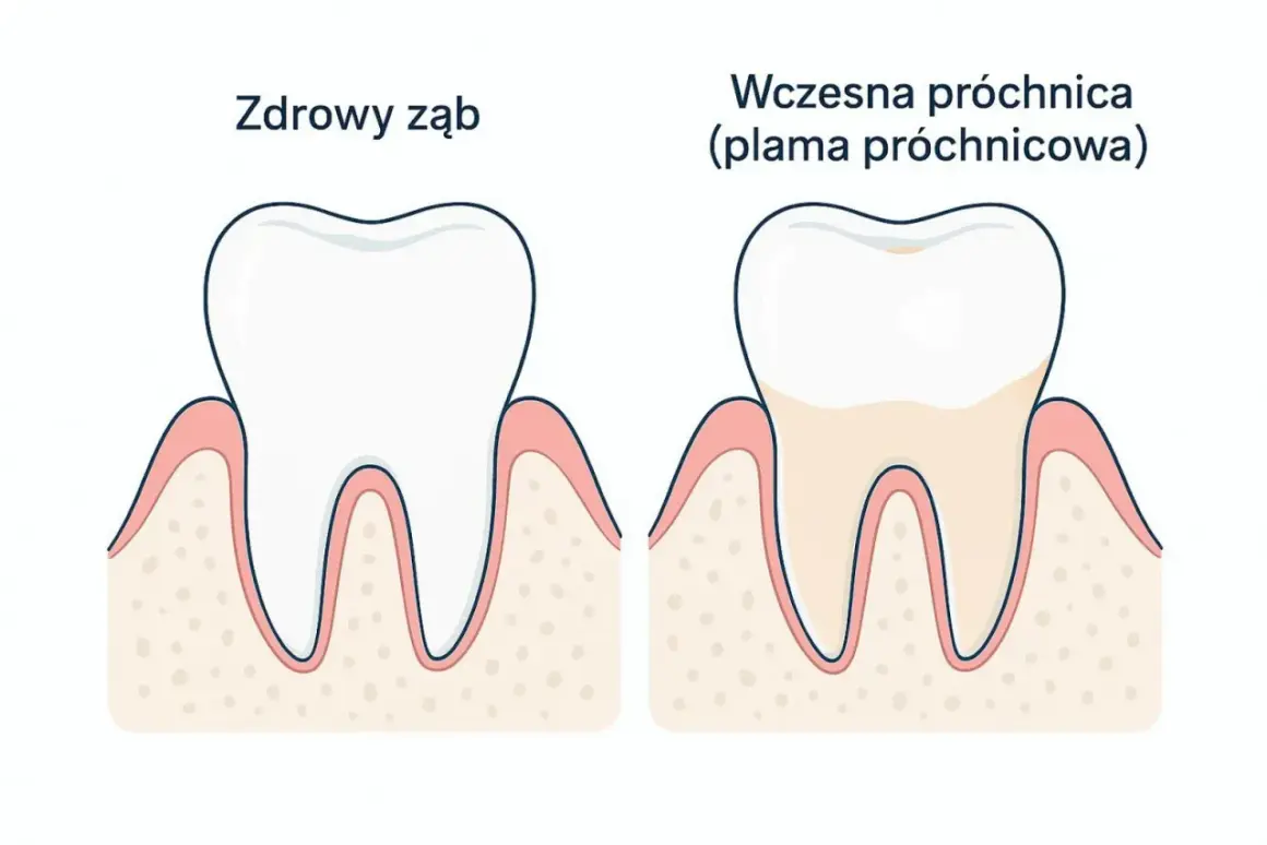 Zdrowy ząb obok zęba z wczesną próchnicą. Wczesne wykrycie plamy próchnicowej to klucz do skutecznego leczenia próchnicy.