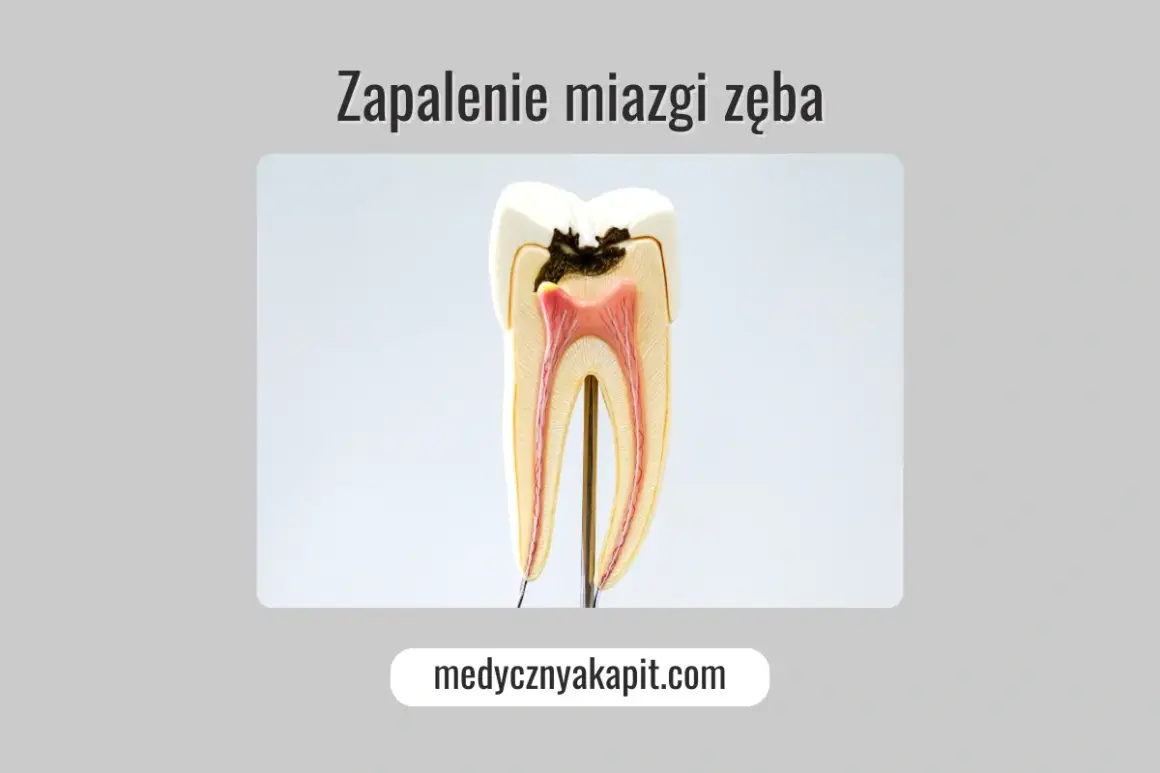 Model zęba ukazujący próchnicę sięgającą miazgi, co może prowadzić do zapalenia miazgi.
