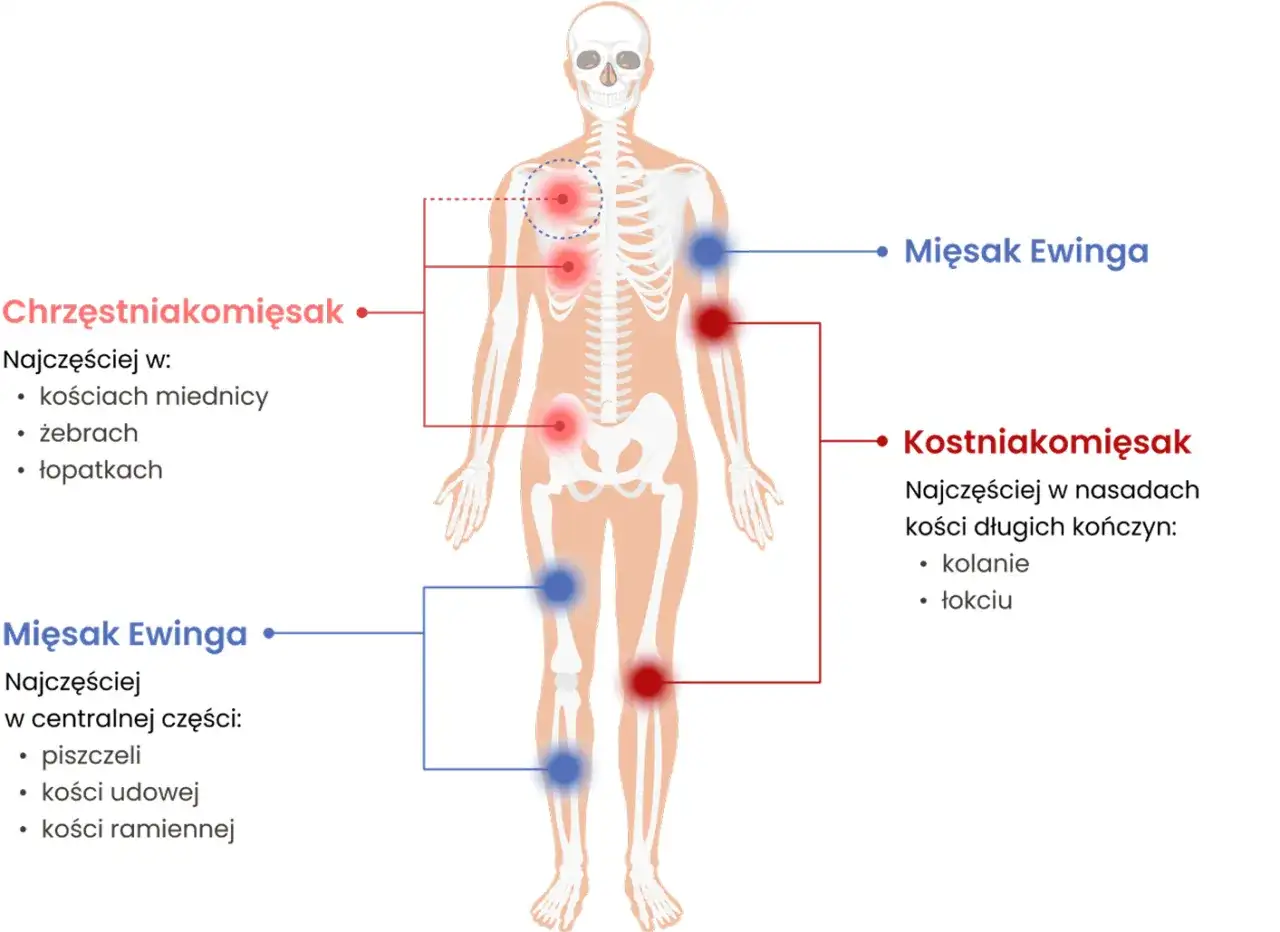 Jak wygląda mięsak tkanek miękkich? Objawy i badania
