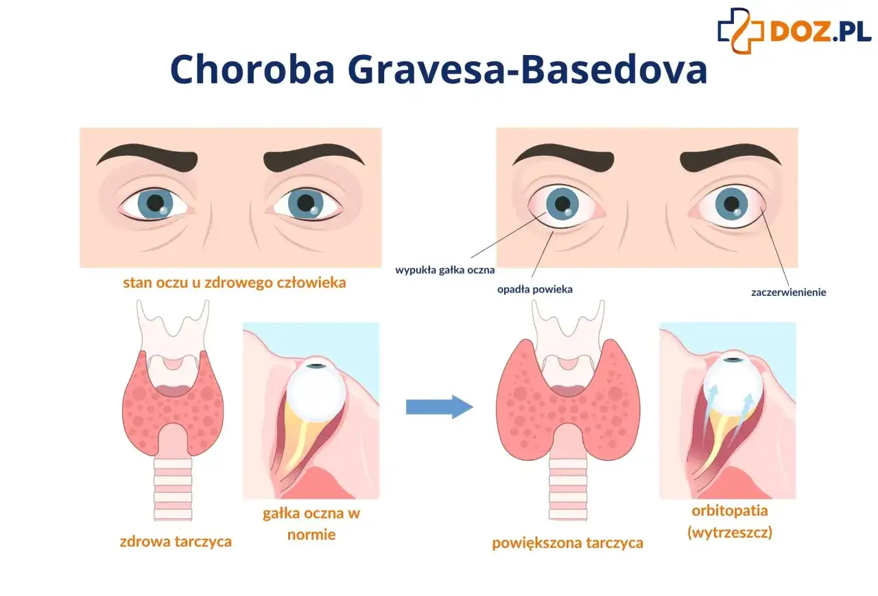 Choroba Gravesa-Basedowa - objawy, badania i leczenie