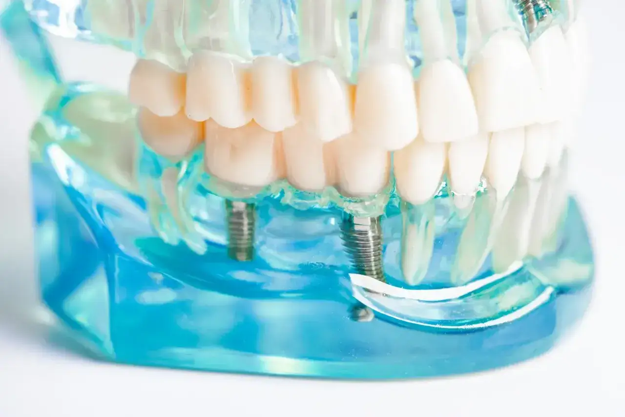 Model szczęki z implantami zębowymi. Widoczne dwa implanty, jeden z nich jest częściowo odsłonięty, co może sugerować odrzucenie implantu zęba.
