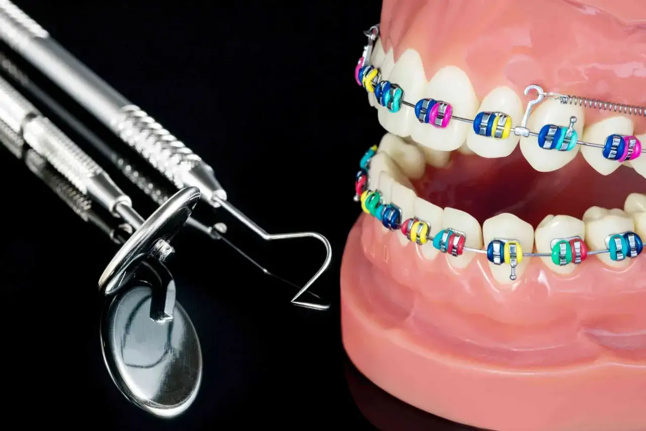 Model szczęki z kolorowym aparatem ortodontycznym, który koryguje zgryz krzyżowy. Obok leżą narzędzia dentystyczne.