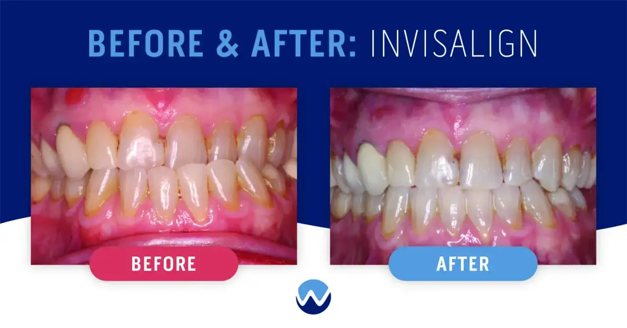 Przed i po leczeniu aparatem Invisalign: zęby przed leczeniem były nierówne i przebarwione, po leczeniu są proste i białe.