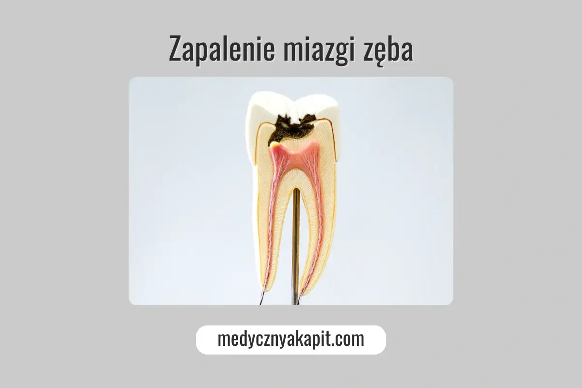 Model zęba z próchnicą i zapaleniem miazgi. Dowiedz się, jak uśmierzyć ból przy zapaleniu miazgi zęba.