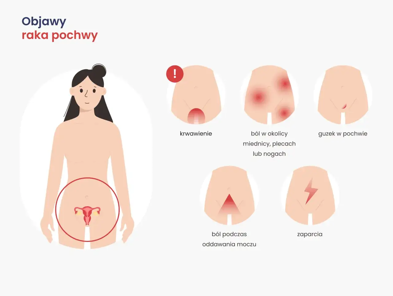 Ilustracja przedstawia objawy raka pochwy: krwawienie, ból w miednicy, guzek, ból przy oddawaniu moczu i zaparcia.