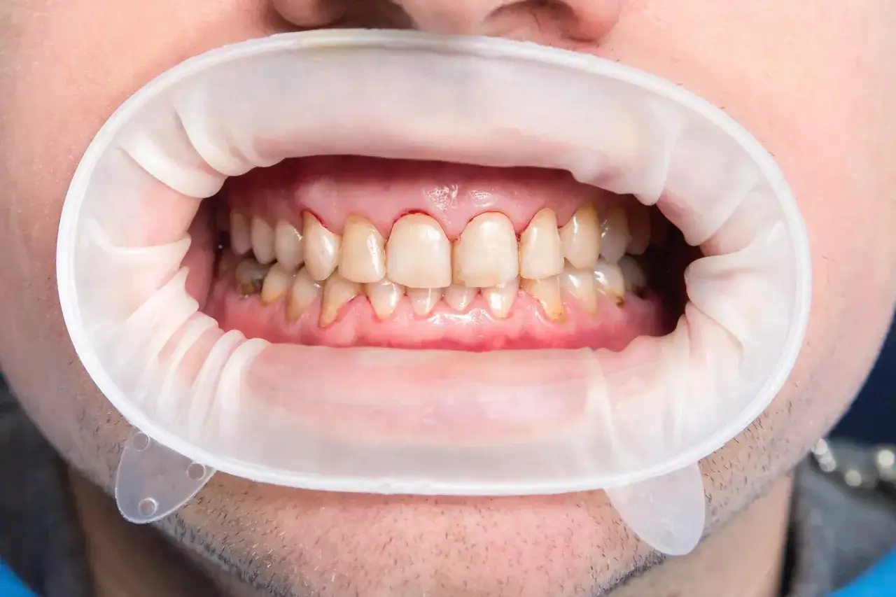 Usta z rozwierakiem dentystycznym, widoczne zęby z przebarwieniami i białymi plamami na szkliwie.