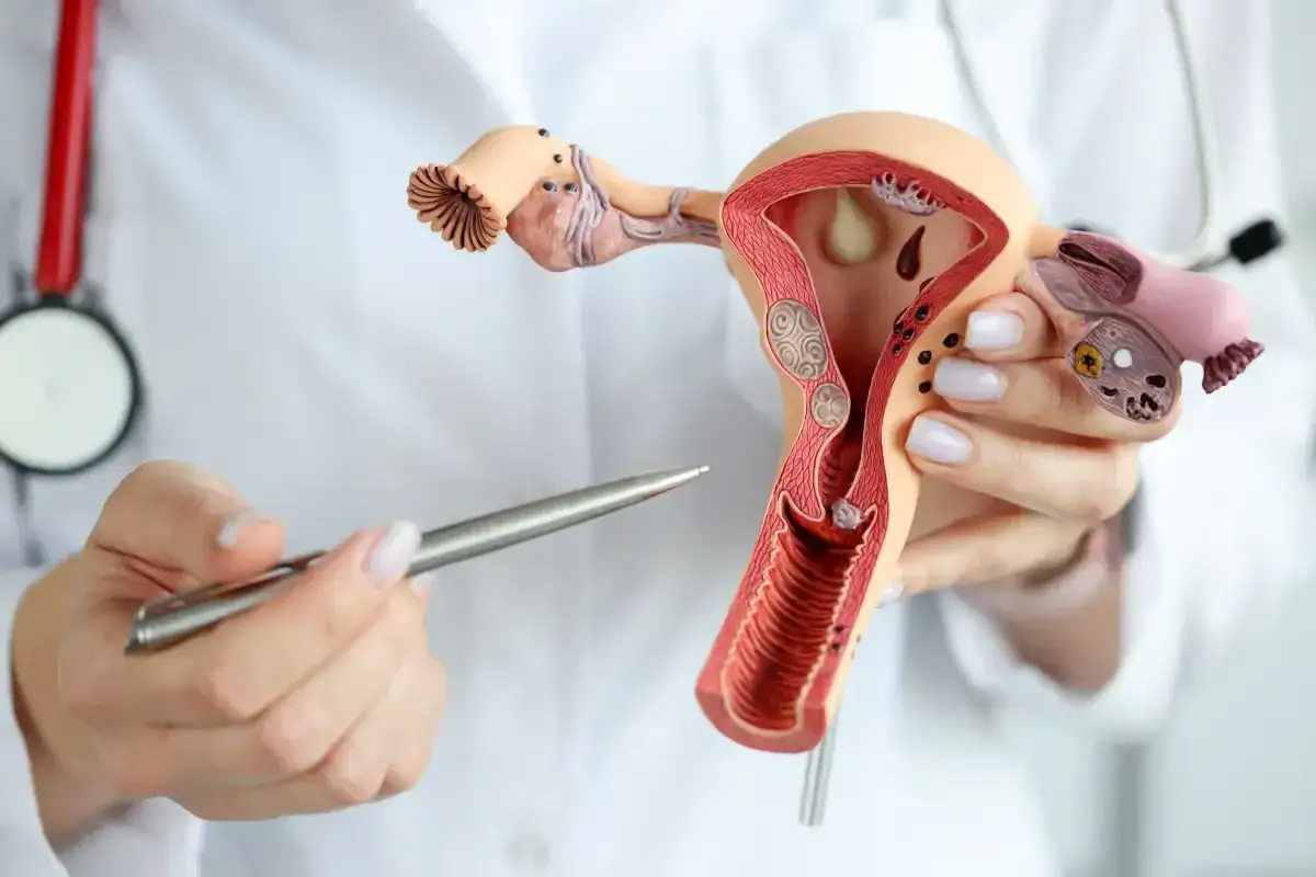 Model narządu rodnego kobiety z widocznymi zmianami, które mogą wskazywać na raka endometrium objawy.