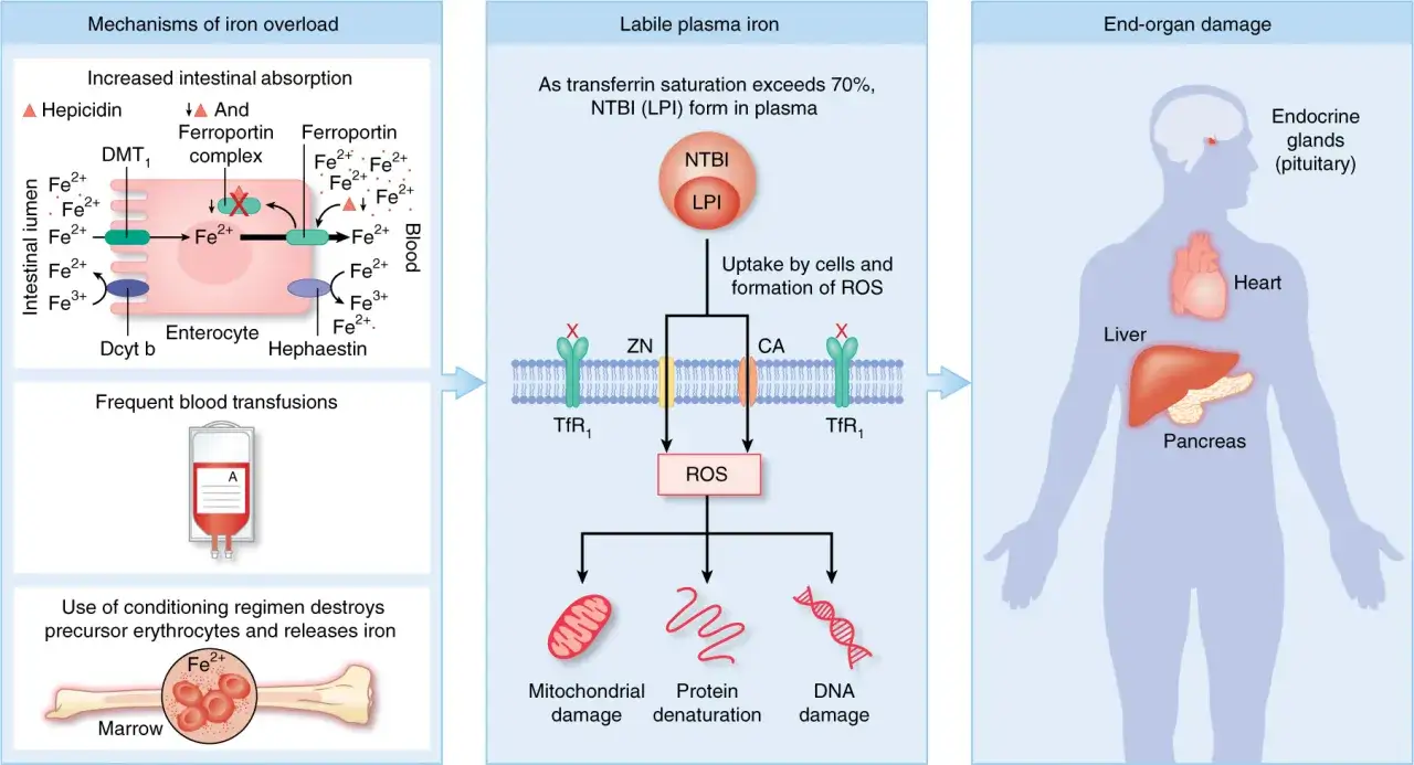 Mechanizmy hemochromatozy: nadmierne wchłanianie żelaza, transfuzje krwi, uszkodzenie szpiku. Nadmiar żelaza prowadzi do uszkodzenia narządów: wątroby, serca, trzustki, przysadki.