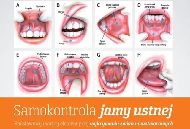 Czynniki ryzyka raka jamy ustnej grafika