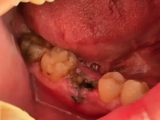 Ból po wyrwaniu zęba - co pomaga i kiedy iść do dentysty?