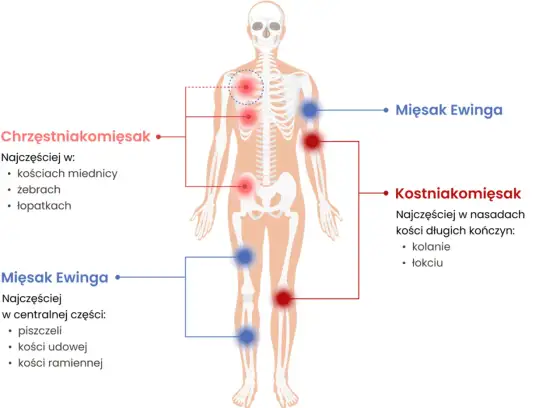 Jak wygląda mięsak tkanek miękkich? Objawy i badania