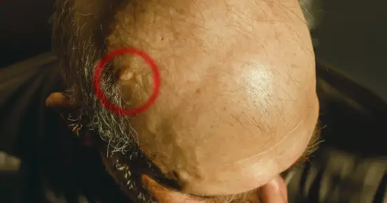 Twardy guzek na głowie pod skórą - co może oznaczać?
