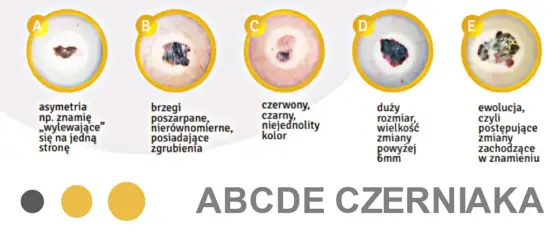 Czerniak na wardze - Jak odróżnić go od zwykłego przebarwienia?