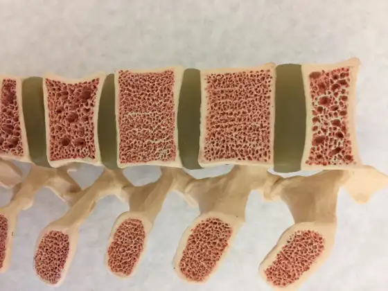 Osteoporoza - objawy, których nie warto ignorować