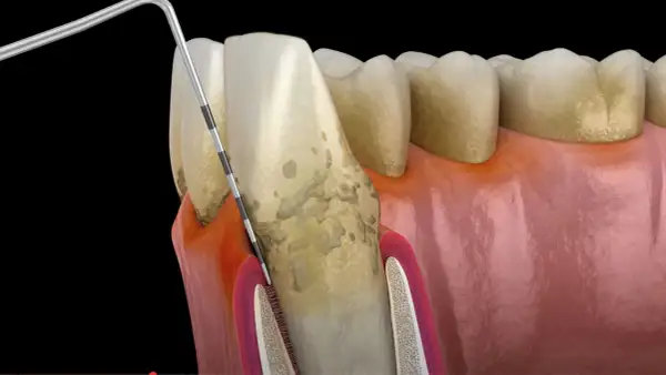 Ząb z kamieniem nazębnym i stanem zapalnym dziąseł. Narzędzie dentystyczne usuwa osad, łagodząc ból wszystkich zębów.