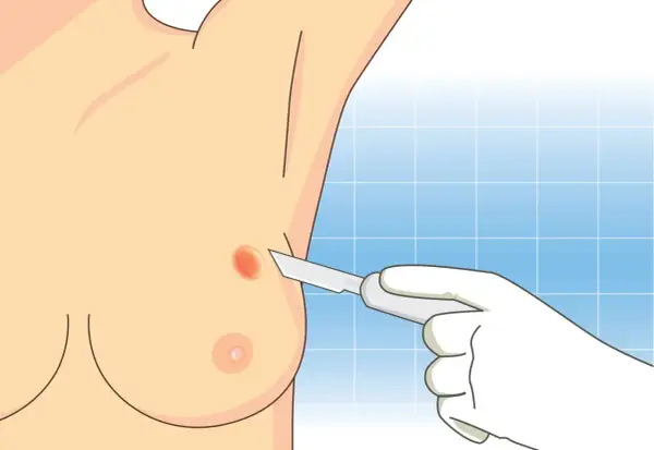Lekarz w białej rękawiczce wykonuje biopsję cienkoigłową podejrzanej zmiany na piersi.