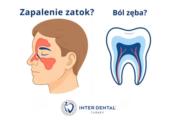 Ilustracja porównuje objawy zapalenia zatok szczękowych z bólem zęba.