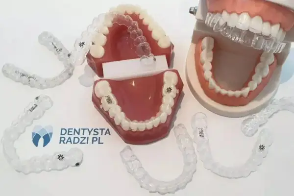 Koszt aparatu ortodontycznego w Polsce: Wszystkie wydatki, raty, NFZ