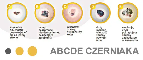 ABCDE czerniaka: asymetria, brzegi, kolor, duży rozmiar, ewolucja. Zmiany na ustach mogą być niepokojące.