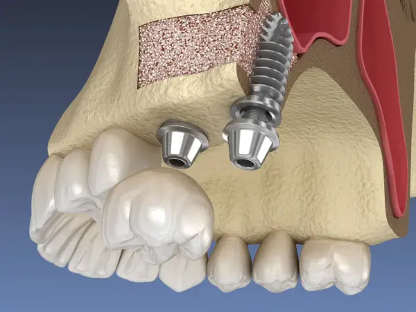 Model szczęki z implantami i podniesionym dnem zatoki szczękowej. Zabieg sinus lift pozwala na wszczepienie implantów w przypadku braku kości.